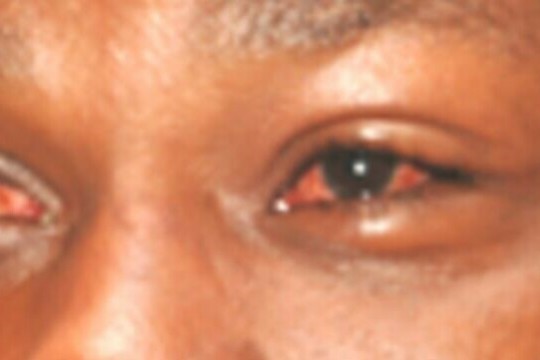 Red eye disease affects 800 in Leer