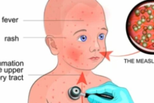 W. Bahr el Ghazal State Health Ministry records 194 measles cases