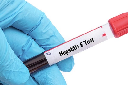 Abyei records 40 cases of Hepatitis E-Sudan
