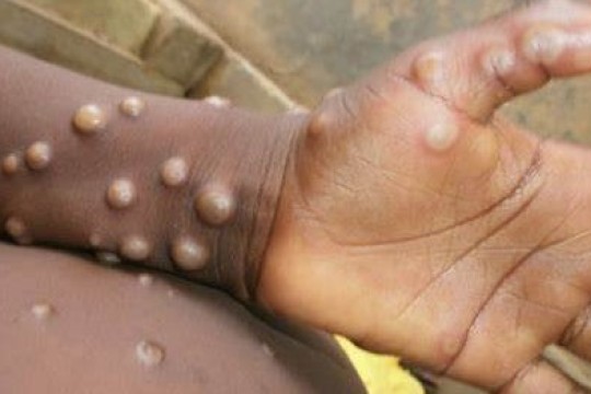 US boosts South Sudan fight against Mpox