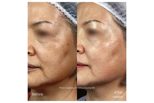 Quanta System unveils the latest breakthrough technology drawn on its picosecond laser heritage: VarioPulse Technology®, the next-level device for the next-level experts