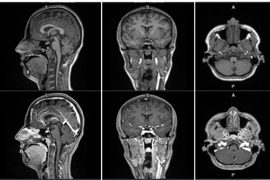 GE HealthCare Announces First Patient Dosed in Phase 2/3 LUMINA Trial for Manganese-Based MRI Contrast Agent Under FDA Fast Track Designation, Further Advancing Its Innovation Pipeline of Novel Imaging Agents