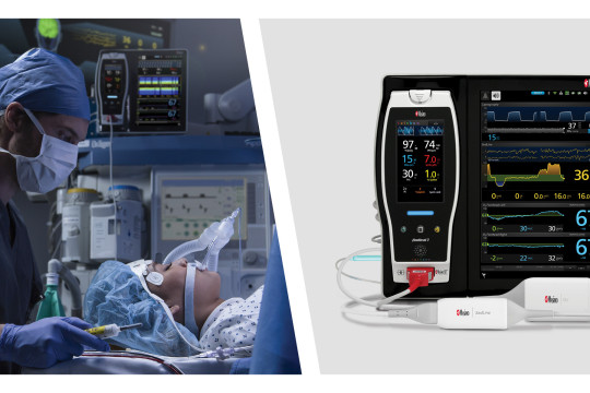 Researchers Harness the Power of Masimo Root®’s Advanced Multimodal Monitoring Capabilities to Study the Impact of Different Ventilatory Strategies on Brain Oxygenation During Thoracoscopic Surgery